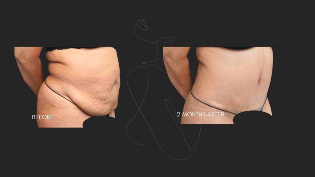 Tummy Tuck (Abdominoplasty ) NYC