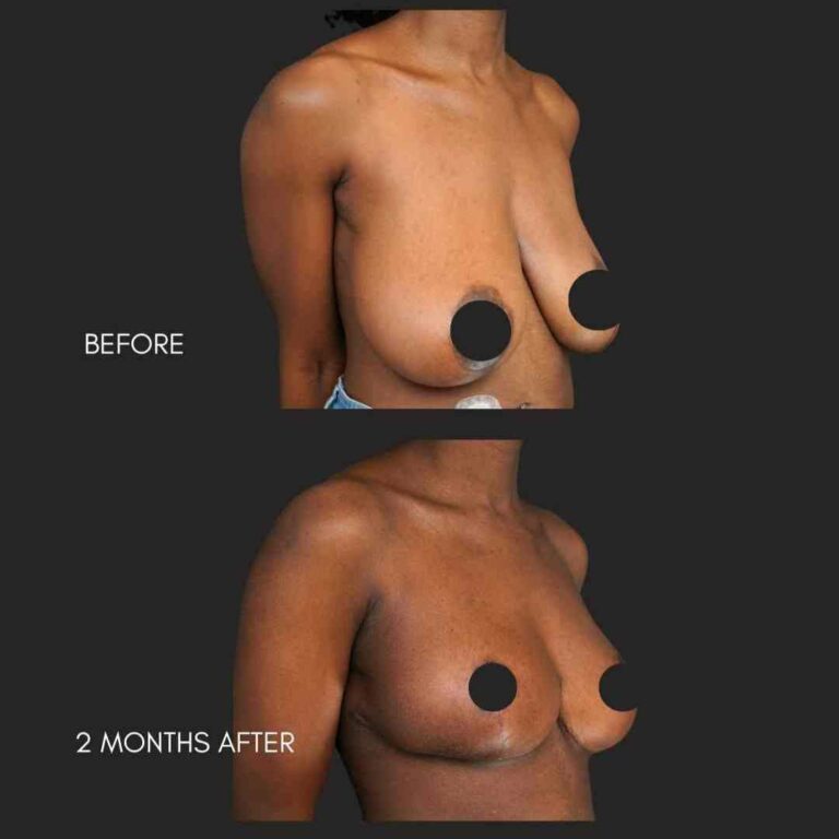 Breast Reduction NYC
