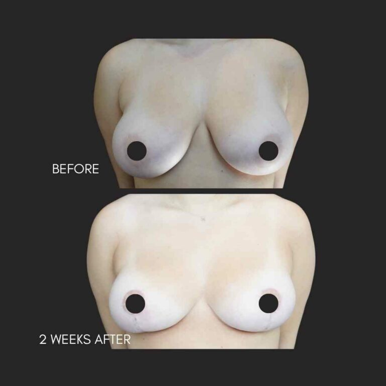 Breast Reduction NYC