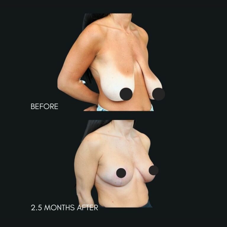 Breast Reduction NYC