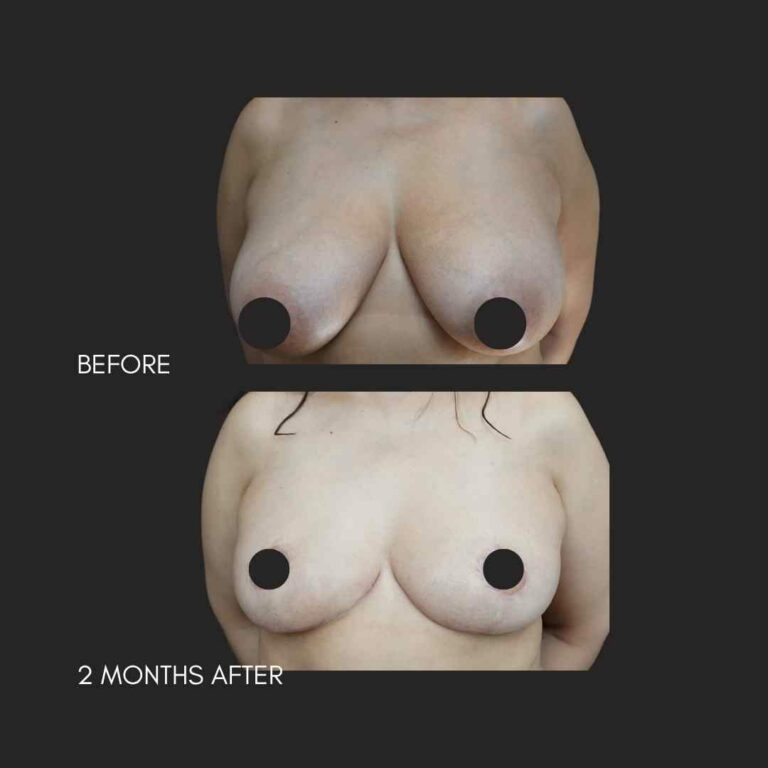 Breast Reduction NYC