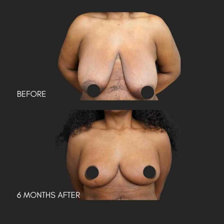 Breast Reduction NYC