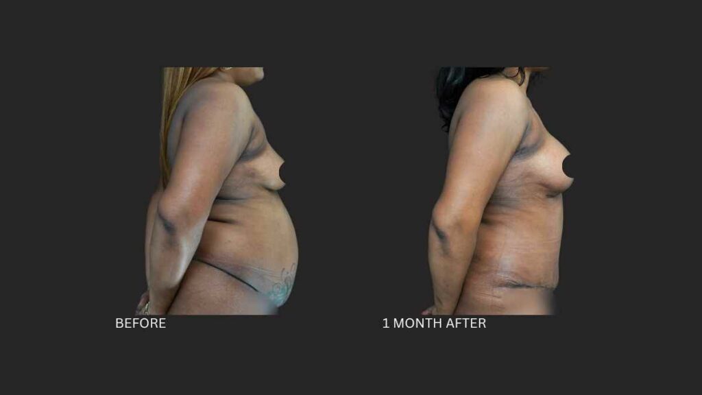 Mommy Makeover NYC