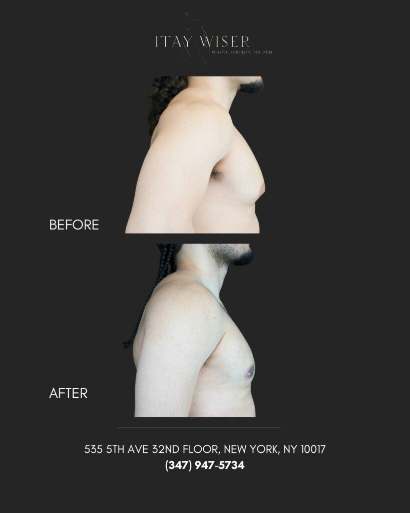 Gynecomastia NYC