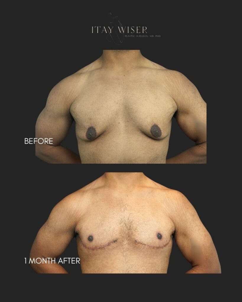 Gynecomastia NYC