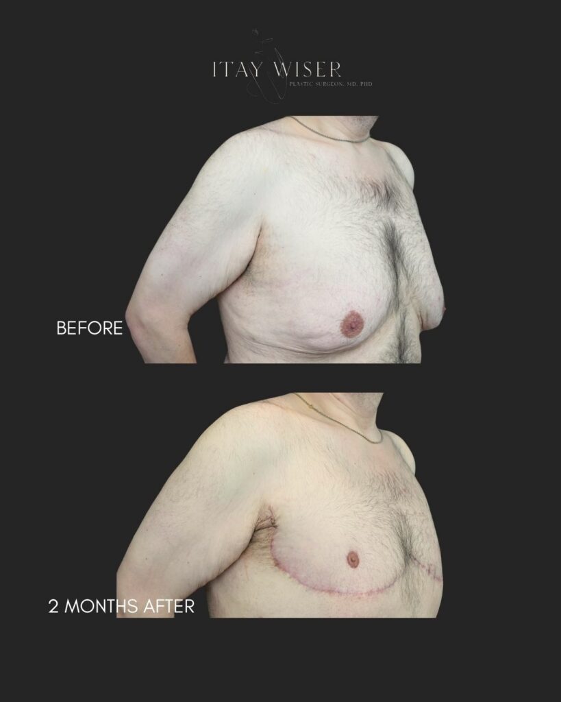 Gynecomastia NYC