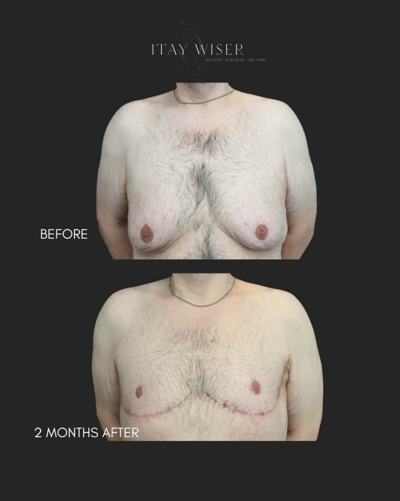 Gynecomastia NYC