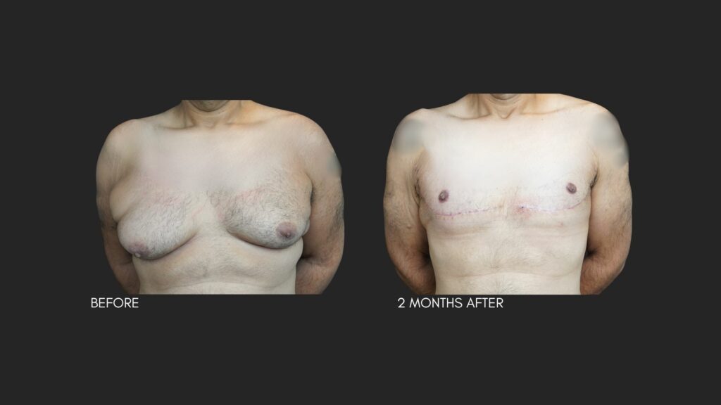 Excessive Skin Gynecomastia NYC