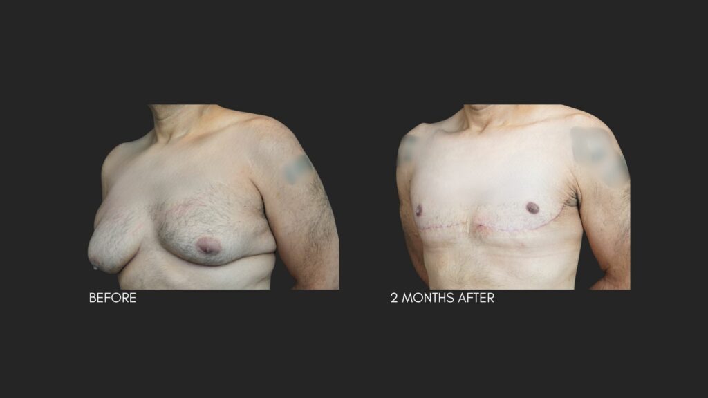 Excessive Skin Gynecomastia NYC