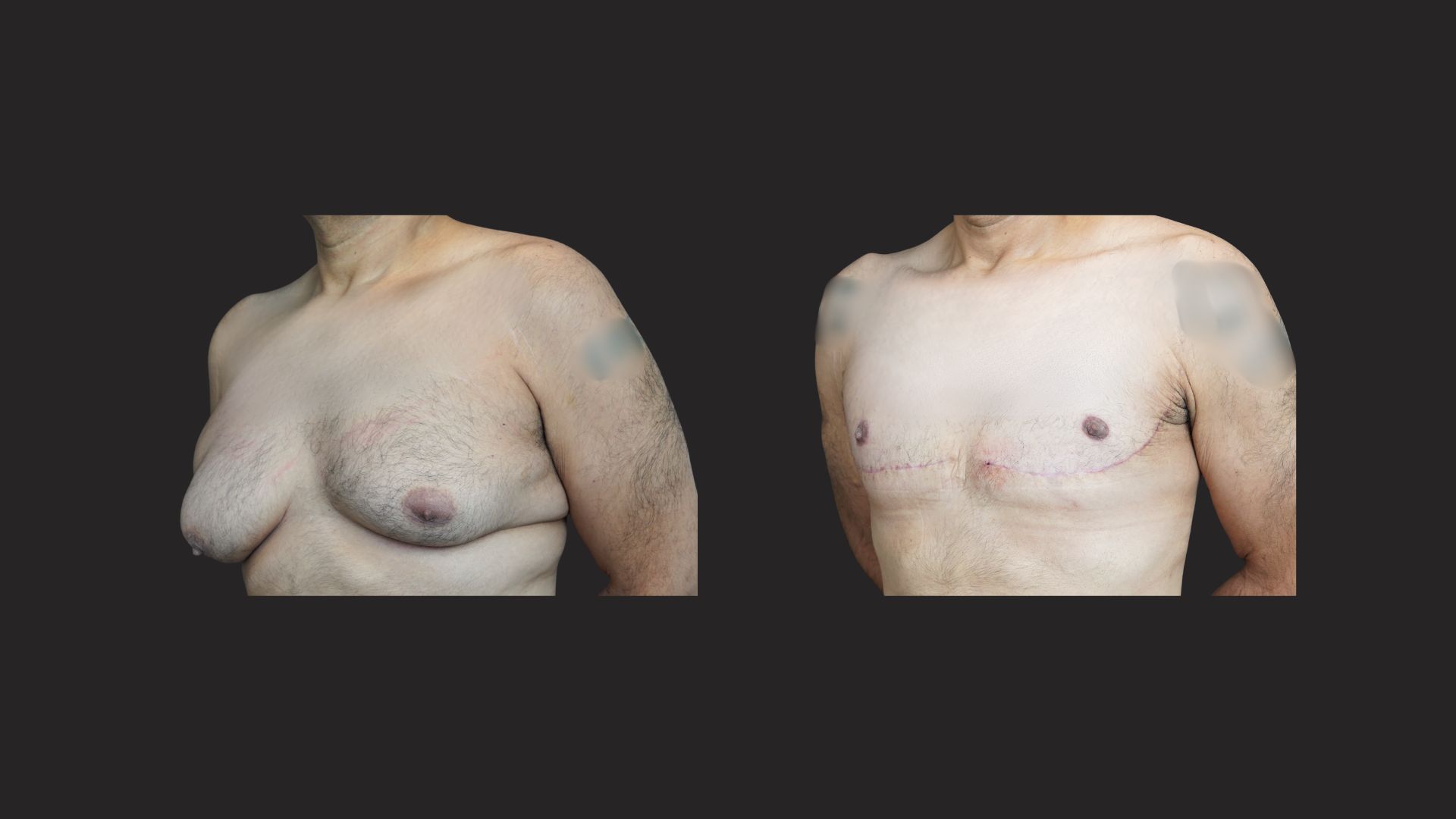 Gallery Excessive Skin Gynecomastia NYC