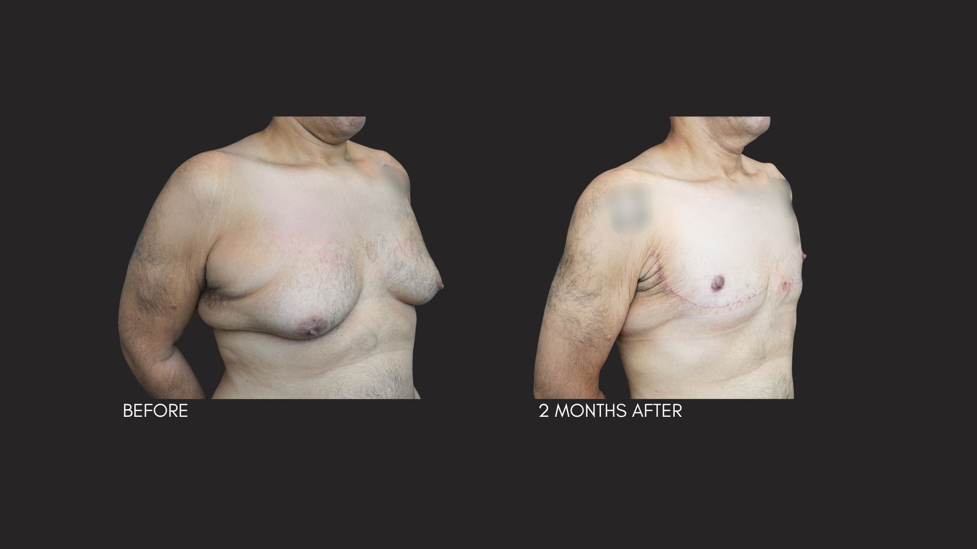 Gallery Excessive Skin Gynecomastia