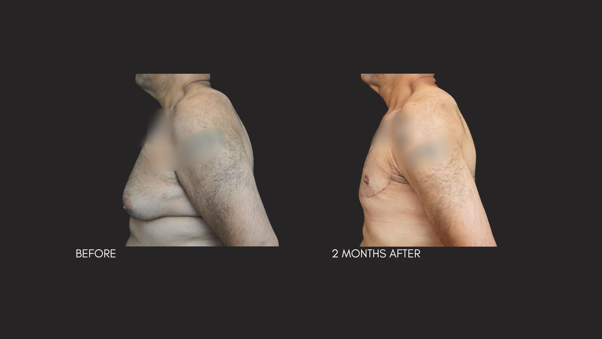 Gallery Excessive Skin Gynecomastia NYC