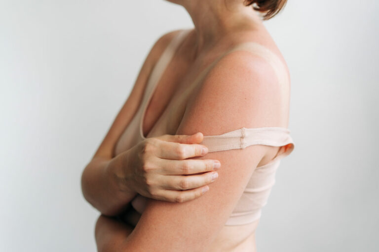 woman showing sunburn on shoulder and upper chest 2026 01 08 08 21 21 utc
